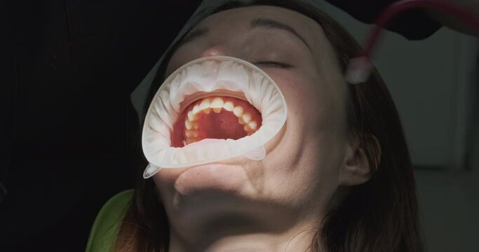 Saliva ejector in dentistry, doctor in gloves takes away excess saliva from patient, process of dental treatment.