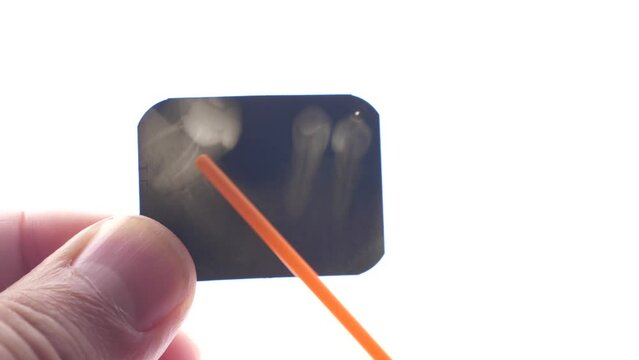 An X-ray image of the teeth is being studied. Dentistry. Diagnostics of dental treatment.