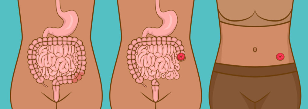 Woman with stoma after colon cancer surgery
