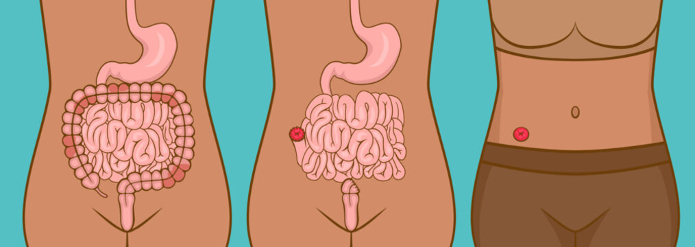 Woman with ileostomy after rectal surgery
