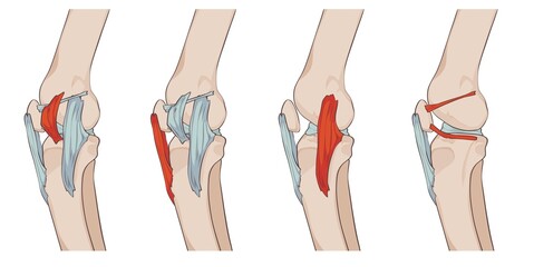 knee ligaments and menisci, with medial patellar retinaculum, medial patellofemoral ligament, patellomemiscal ligament, tibial collateral ligament and patellar ligament, jpg
