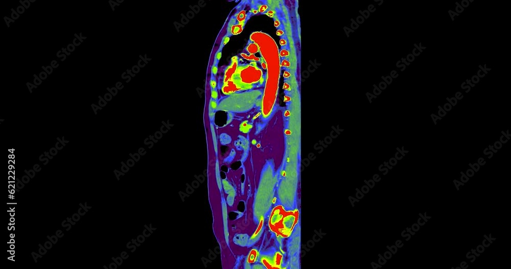 Poster ct scan of chest and abdomen in colorful mode look like pet ct scan.