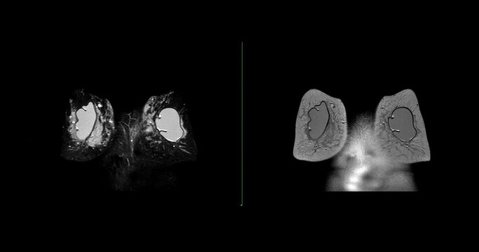 Breast MRI magnetic resonance imaging of the breast in case Breast implants for screening for breast cancer.