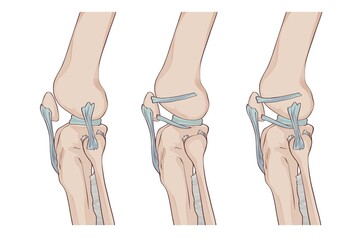 knee ligaments and menisci, with lateral patellofemoral ligament, patellomeniscal ligament, patellar ligament and fibular collateral ligament, jpg