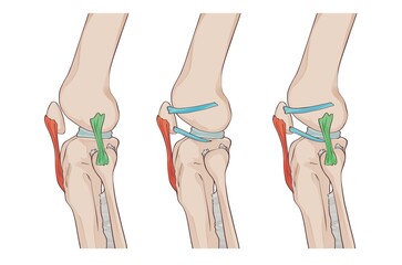 knee ligaments and menisci, with lateral patellofemoral ligament, patellomeniscal ligament, patellar ligament and fibular collateral ligament, jpg