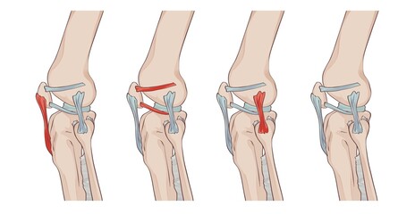 knee ligaments and menisci, with lateral patellofemoral ligament, patellomeniscal ligament, patellar ligament and fibular collateral ligament, jpg