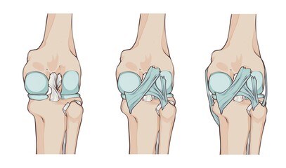 knee ligaments and menisci, with oblique popliteal ligament, medial fascicle of arcuate popliteal ligament, lateral fascicle of arcuate popliteal ligament and tibial collateral ligament 
