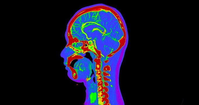 CT Scan of the brain sagittal plane in color mode for diagnosis stroke diseases.