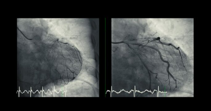 Cardiac catheterization showing coronary arteries  used to diagnose and treat some heart conditions such as myocardial infarction.