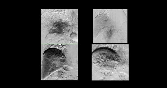 TACE or Chemoembolization is a procedure that allows a dose of chemotherapy drugs to be administered directly to Liver tumor or HCC showing hepatic artery.
