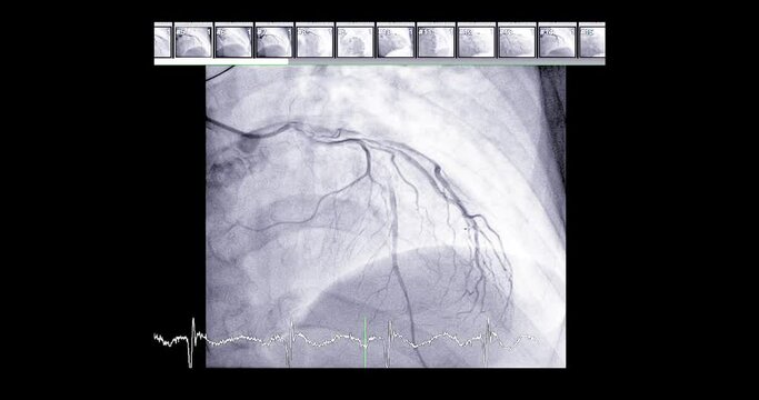 Cardiac catheterization showing coronary arteries  used to diagnose and treat some heart conditions such as myocardial infarction.