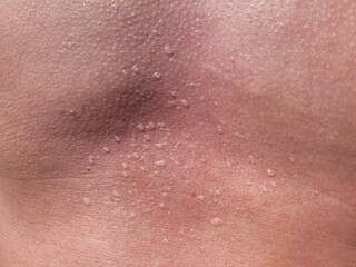 Sunburn on the skin with blisters. Sunburn is the result of prolonged exposure to the sun without sunscreen or lotion