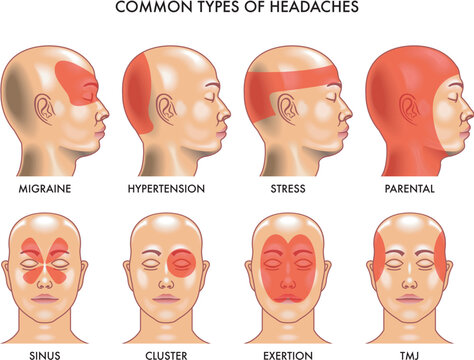 Medical Illustration of common types of headaches.