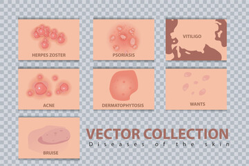 Different types of psoriasis vector set. Part of patients skin with dermatitis, inflammation, red rash and other skin problems vector illustration suitable for women's skin health problems
