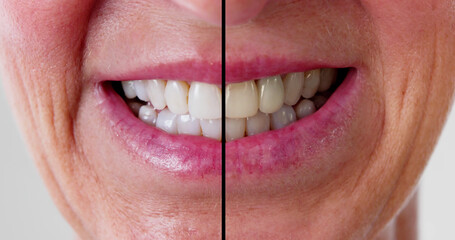 Female Teeth Between Before