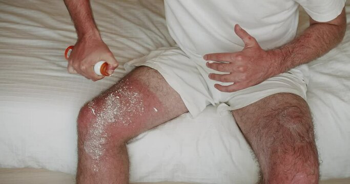 Man applying a therapeutic cream on a sunburn on the skin of the leg. Applying of sunscreen cream on red sunburned skin. white splashes. Sensitive skin due to sun exposure.