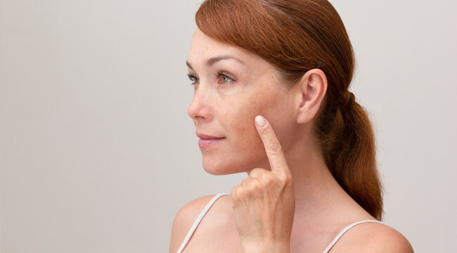 Portrait Of Cropped Caucasian Middle Aged Woman Face With Freckles Showing On Skin By Index Finger On White Background