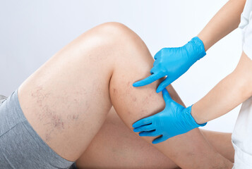 doctor shows  the dilation of small blood vessels of the skin on the leg. Medical inspection and...