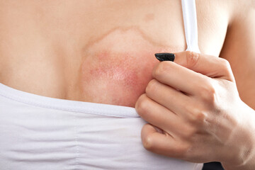 A woman shows a burn on her chest, healing of the skin after a burn with boiling water....