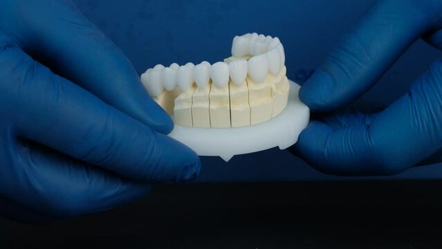 Model with dental veneers created by the dental technician