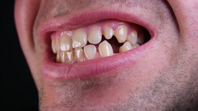 Close up of male jaw with slightly yellowish teeth and or spaces in between them.