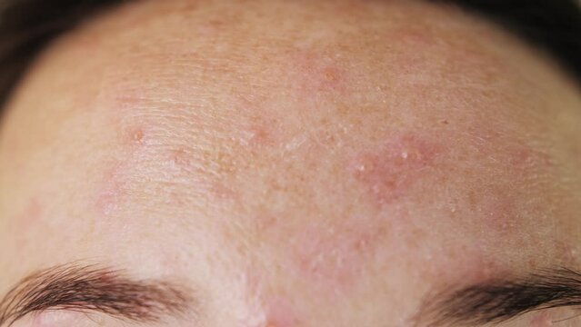 Itching on the skin for chickenpox in an adult. Many red rashes and pockmarks on the face.