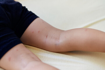 Many of mosquito bites sore and scar on child legs, a boy scratching at lesion.