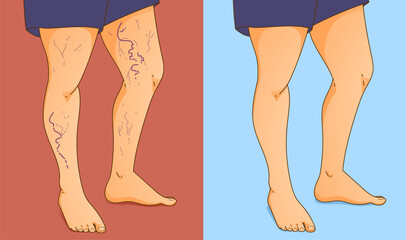Human body with health problems. Varicose veins. Before, after. Vector illustration. Healthcare illustration.  - obrazy, fototapety, plakaty