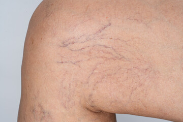 Fototapeta premium Varicose veins on female leg