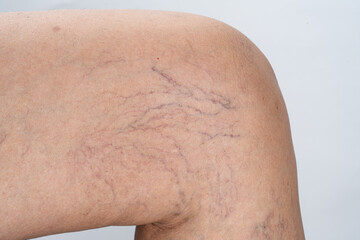 Varicose veins on female leg
