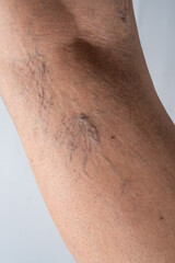 Varicose veins on female leg