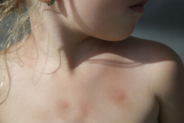 Little girl has skin rash from allergy or mosquito bites
