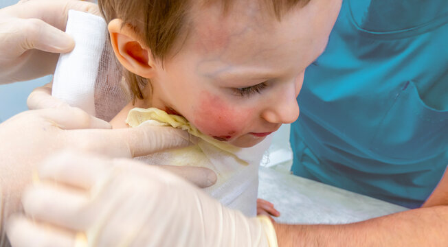 dressing a boy with a burn from boiling water