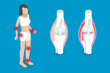 3D Isometric Flat Vector Conceptual Illustration of Rheumatism, Osteoarthritis and Rheumatoid Arthritis