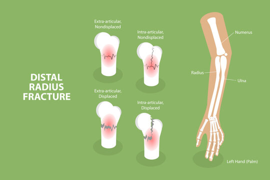3D Isometric Flat Vector Conceptual Illustration of Distal Radius Fracture, Labeled Educational Diagram