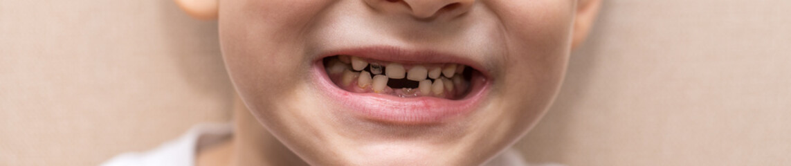 a six-year-old boy shows missing teeth. close-up portrait