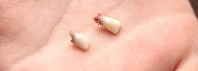 fallen milk teeth in the palm of a child. close-up