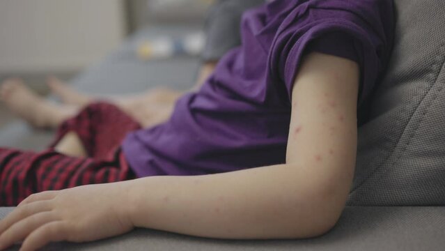 viral disease childhood illness chicken pox pimples symptoms on child's body arm leg and back. preschooler skin with varicella chickenpox red spots. itchy dermatological allergy reaction. health care