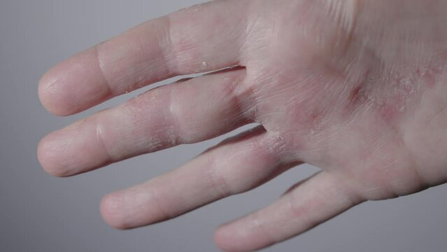 scary hideous looking skin hand affected with skin disease. scabs dry redness flaking inflammation reaction on allergy food intestine problems health concept. 