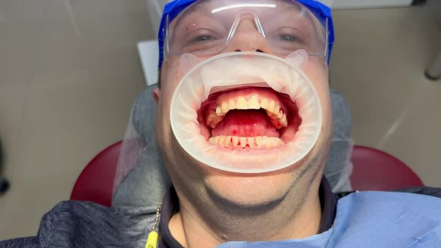 The face of a patient in protective glasses with a wide open mouth of a young man in a dental clinic after a professional cleaning of the oral cavity. Bleeding gums after an ultrasonic dental scaler. 