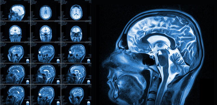 Magnetic resonance imaging of the brain with no visible abnormalities. MRI in different views