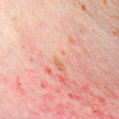 Keratosis or papilloma on the skin of an adult. Irritation or allergic reaction.