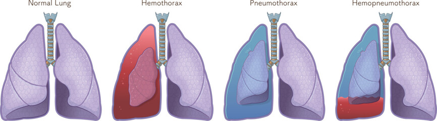 lungs,windpipe,hemothorax,pneumothorax,hemopneumothorax,illustration