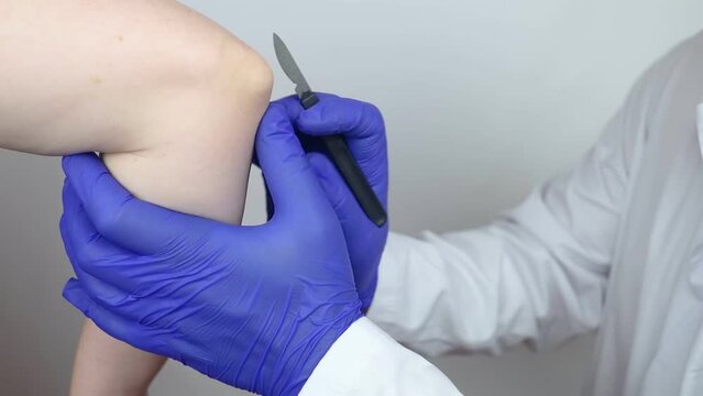 Elbow surgery. Surgeon shows the patient where the incision will be with a scalpel for operation due to tendon rupture, cartilage damage, bone prick. Concept of restoring joint mobility and arthroplas