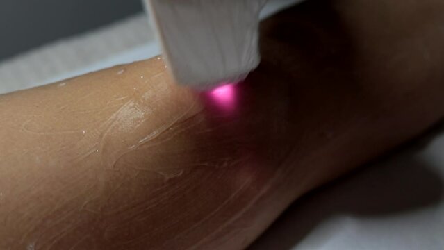 Beautician removes hair on female legs. Laser hair removal treatment at beauty salon. Laser hair removal close-up. Slow motion.
