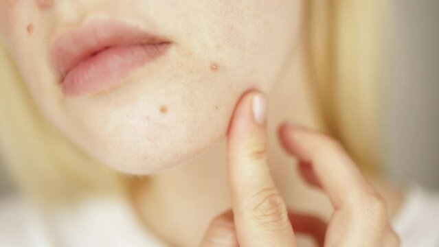 Problems face skin with acne and enlarged pores. Woman touching her face with a pimple.