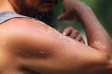 Peeling of the skin after sunburn. Hand of a bearded man close-up. The concept of using sunscreen....