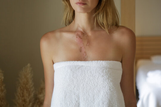 A second-degree burn with peeling skin on woman's chest	