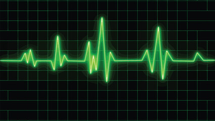 Electrocardiogram show (STEMI) pattern. Heart attack. Ischemic. Coronary artery disease. Angina pectoris. Chest pain. ECG. EKG. Medical health care.