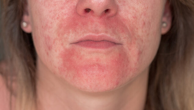 Seborrheic Dermatitis In the face of a young girl. Acne vulgaris and scars over whole face of Italian woman. close-up with focus on the problem.